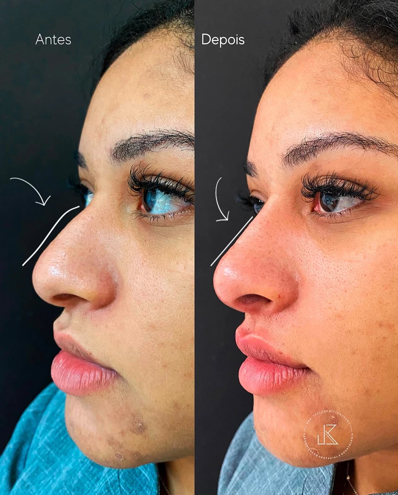 Registro 01 de antes e depois fornecido pela Dra. Joelane Bittencourt: harmonia do perfil