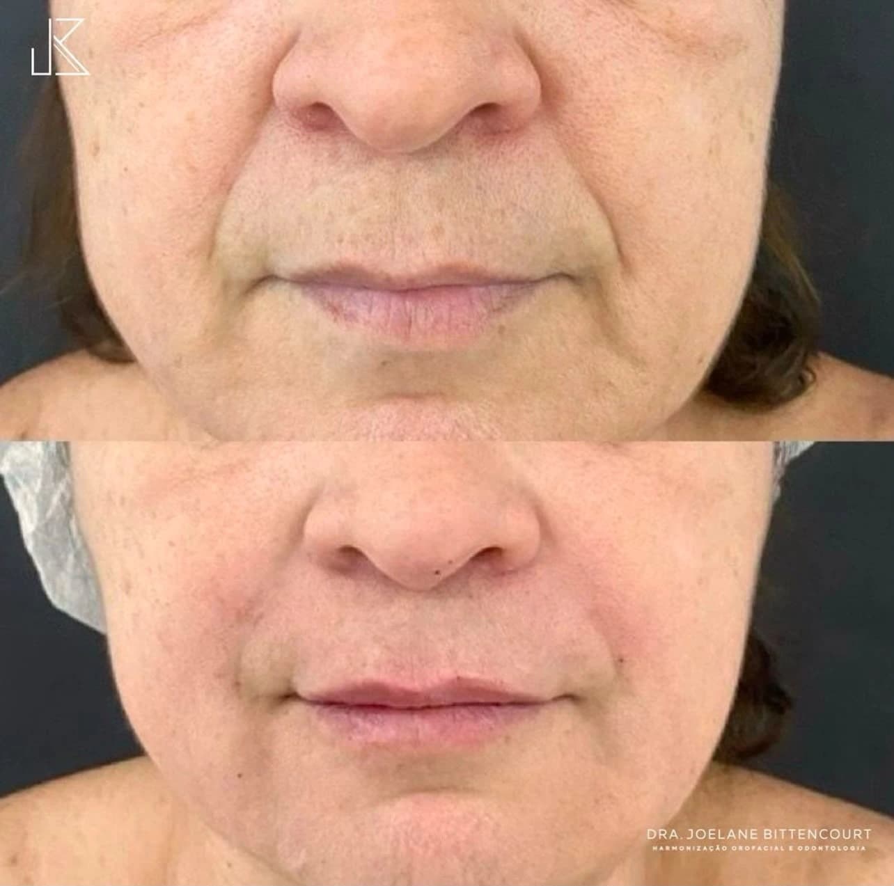 Registro 02 de antes e depois fornecido pela Dra. Joelane Bittencourt: a beleza dos detalhes