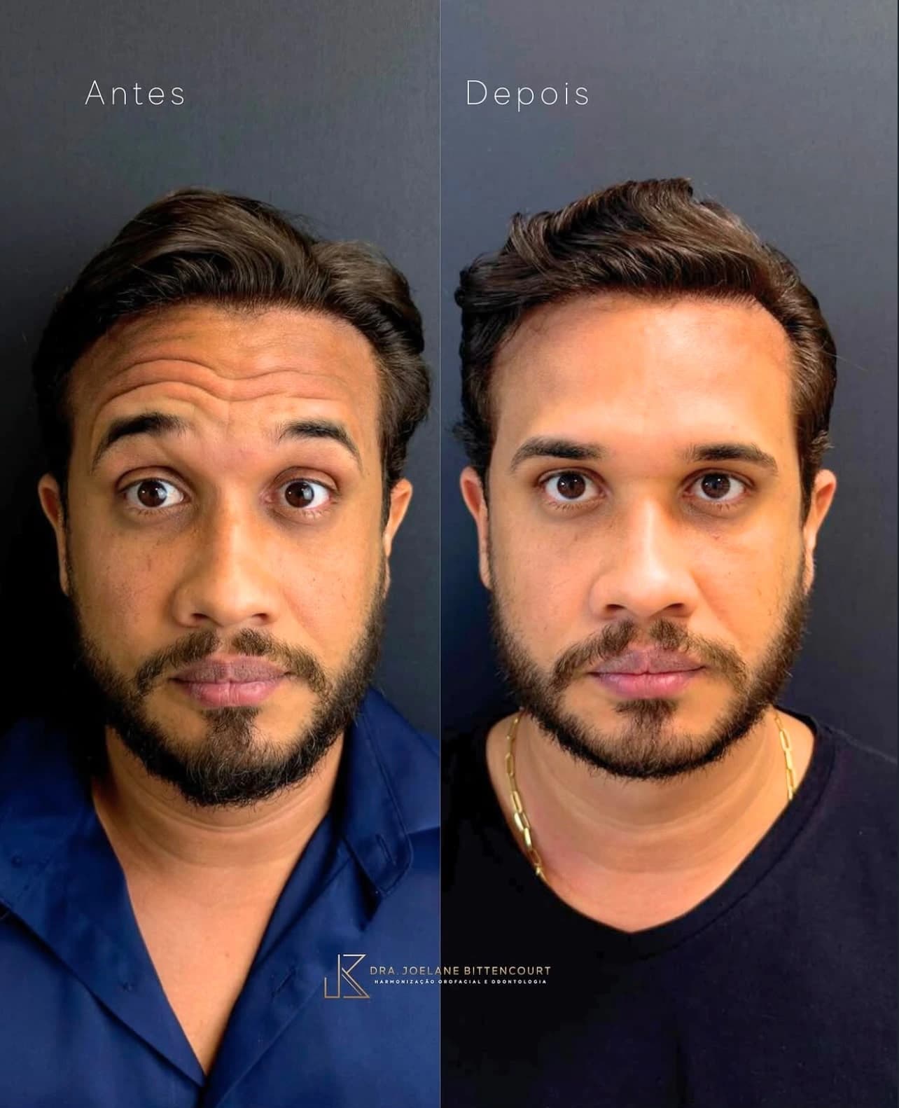 Registro 03 de antes e depois fornecido pela Dra. Joelane Bittencourt: leveza na expressão