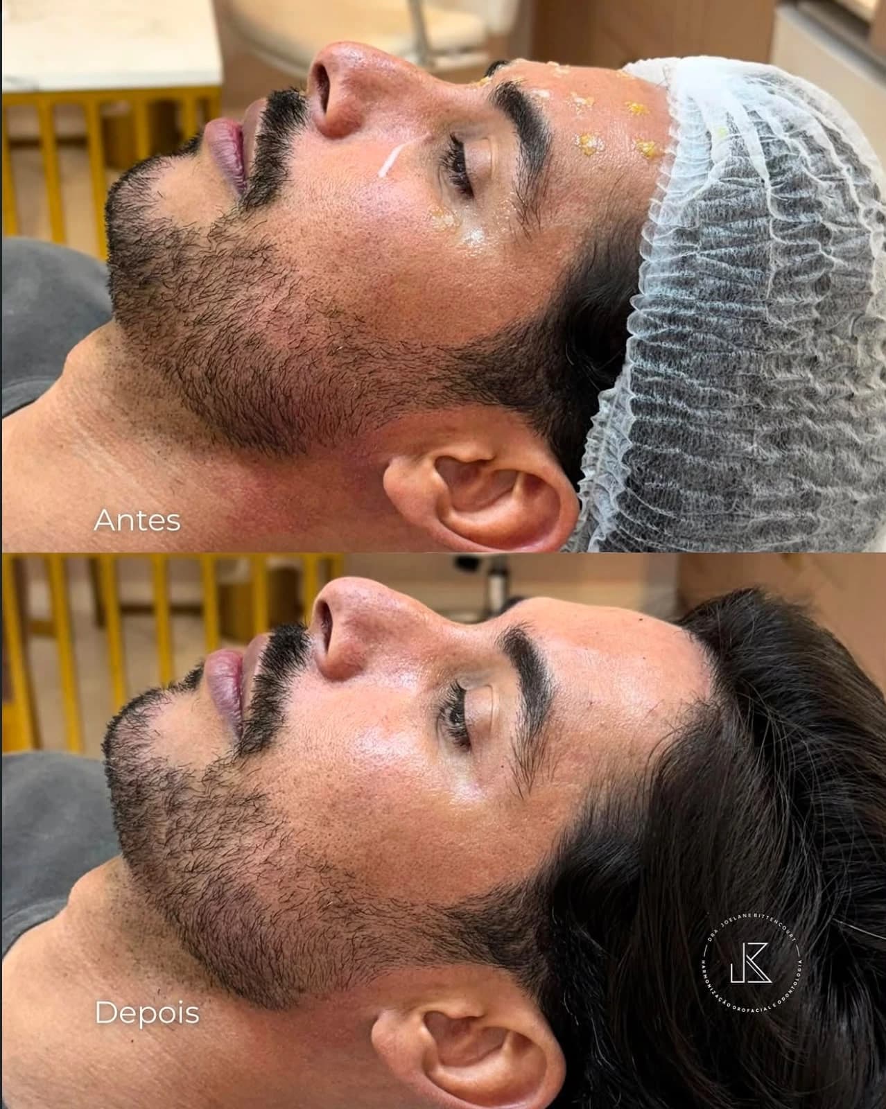 Registro 04 de antes e depois fornecido pela Dra. Joelane Bittencourt: equilíbrio dos contornos