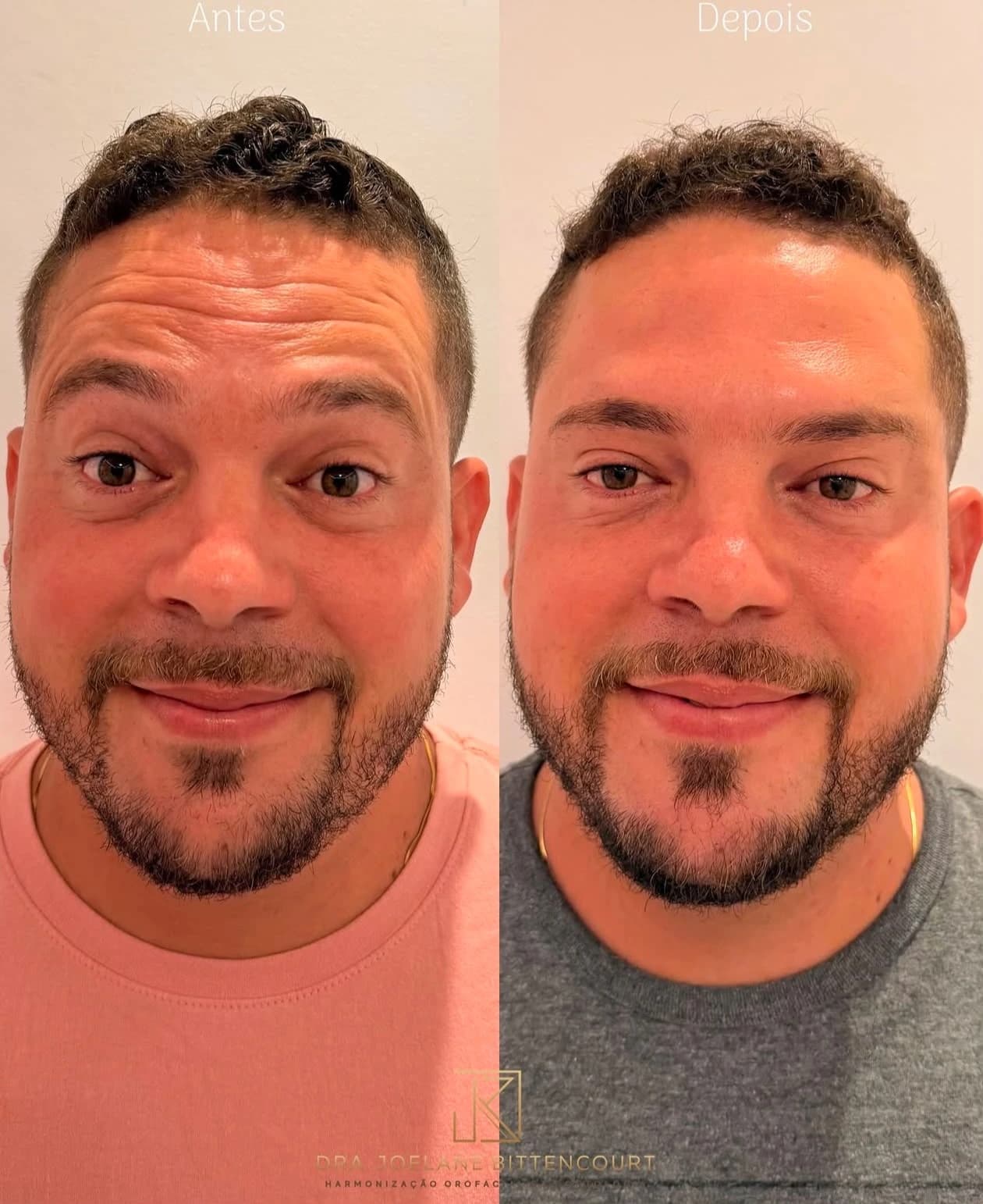 Registro 06 de antes e depois fornecido pela Dra. Joelane Bittencourt: expressão e naturalidade