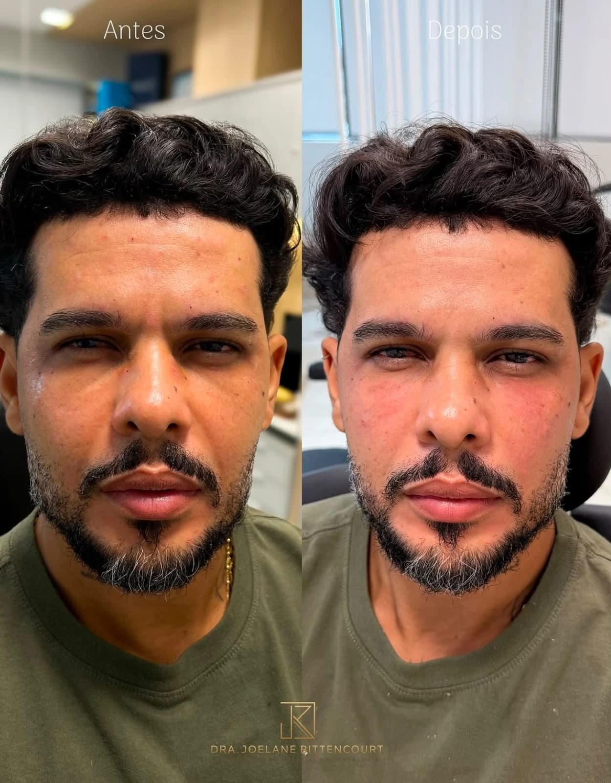Registro 07 de antes e depois fornecido pela Dra. Joelane Bittencourt: um olhar renovado