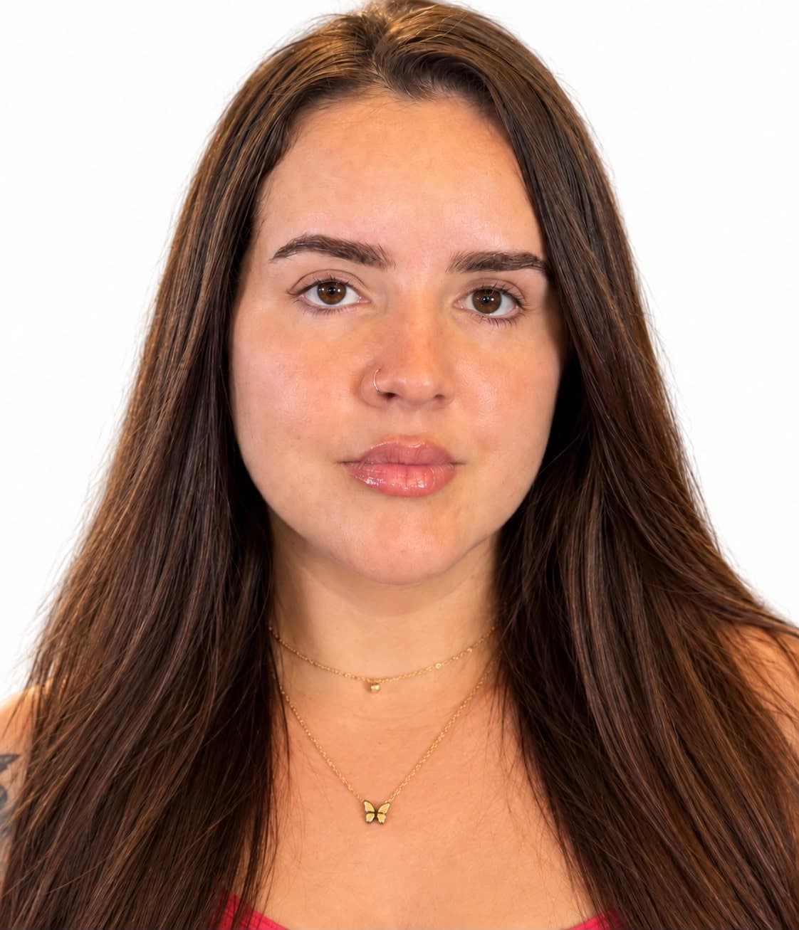 Roseli: registro após o tratamento, fornecido pela Dra. Joelane